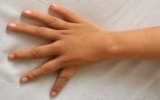 Bé gái có bàn tay 6 ngón giống hệt nhau