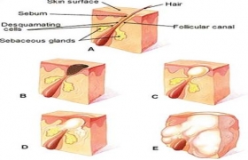 Những điều chưa biết về mụn trứng cá