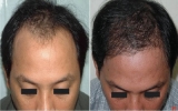 Phục hồi tóc cho người bị hói
