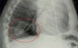 Hạt đậu nảy mầm trong phổi người