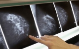 Những bí mật liên quan đến bệnh ung thư vú