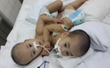 越南一对连体双胞胎成功接受分离手术