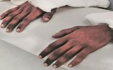 Đôi tay da đen chuyển màu sau khi cấy ghép cho người phụ nữ da sáng