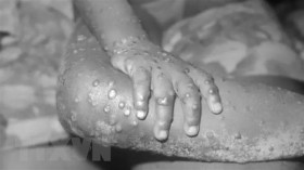Những "thuyết âm mưu" lan truyền về bệnh đậu mùa khỉ trên thế giới