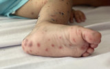 Vaccine phòng tay chân miệng đầu tiên ở Việt Nam có hiệu quả 96,8%