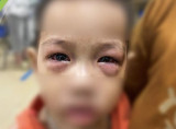 Cảnh báo dịch đau mắt đỏ ở trẻ em kèm theo nhiều biến chứng